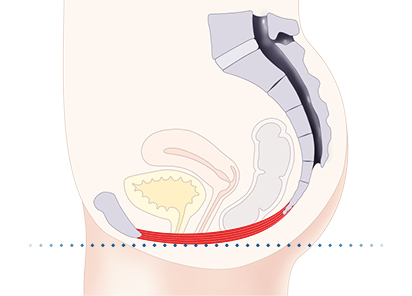 Effective incontinence treatment