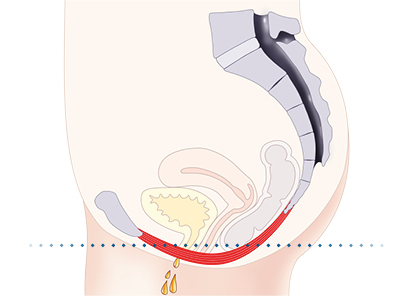 Emsella Incontinence treatment