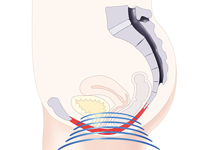 Treating incontinence in NZ